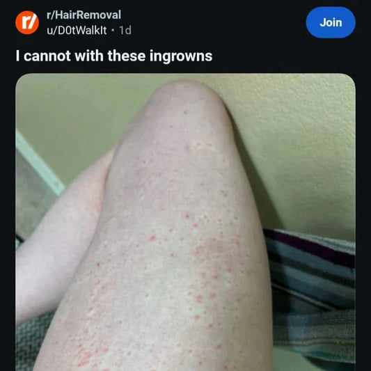 A South Asian Pakistani woman with strawberry legs and ingrown hair suffering from PCOS and Hirsutism