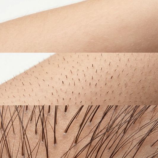 A three-panel comparison of hair textures on South Asian skin, showing fine vellus peach fuzz, sharp dark stubble, and thick coarse terminal hair.