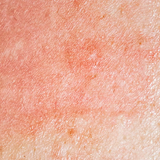 Close-up of human skin displaying mild redness and erythema, helping readers visually identify a standard histamine allergic reaction versus a severe clinical laser burn after hair removal.