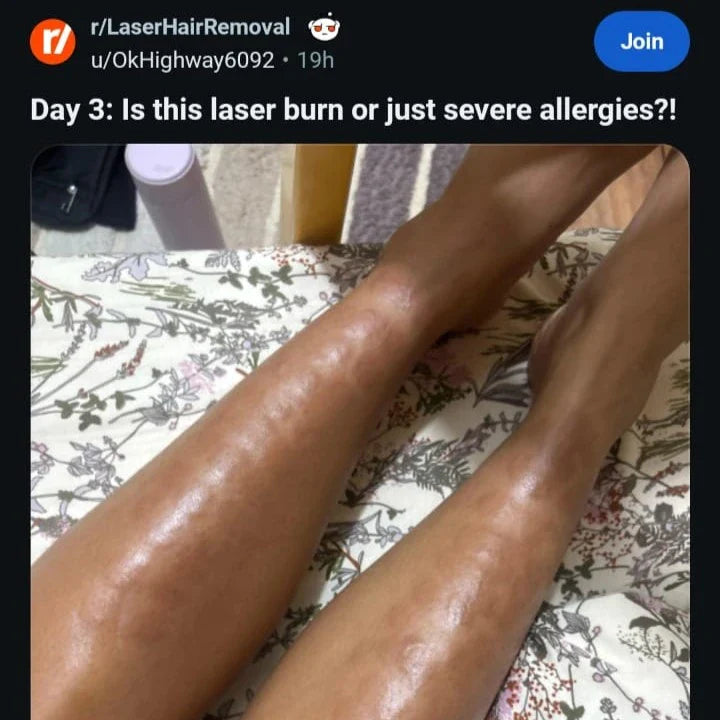 A Reddit post showing severe laser hair removal burns on legs with distinct geometric round marks and tracking lines caused by clinical treatment complications.